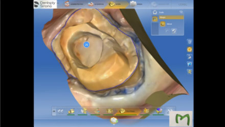 CAD/CAM - Αποκατάσταση σε ενδοδοντικά θεραπευμένο δόντι