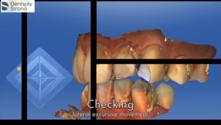 CAD/CAM - Όλοκεραμική όψη σε δόντι χωρίς τροχισμό