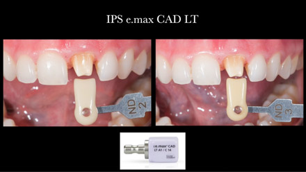 CAD/CAM - Αποκατάσταση σε δυσχρωμικό δόντι