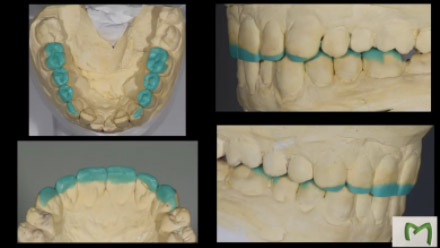 CAD/CAM - Αποκατάσταση φθαρμένης οδοντοφυΐας