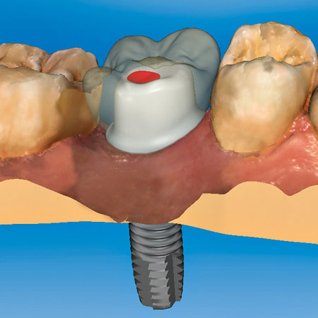 ΕΜΦΥΤΕΥΜΑΤΟΛΟΓΙΑ - Αντικατάσταση ελλείποντων δοντιών